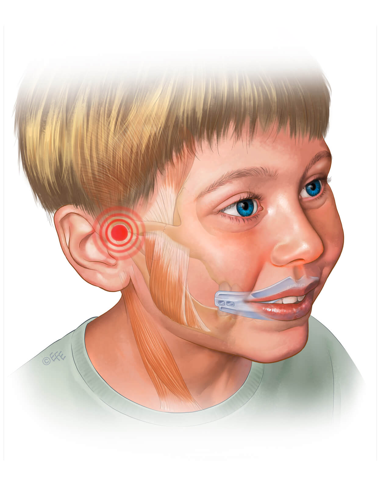 MOJO splint boy
